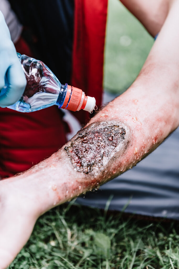 First aid paramedic in training, treating third degree burns